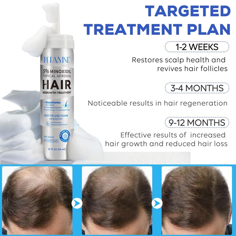 5% Minoxidil Hair Growth Foam, Minoxidil for Men and Women, Hair Regrowth for Men, Beard Growth, Treatment for Scalp Hair Loss Hair Thinning - Increase Thickness and Volume Faster