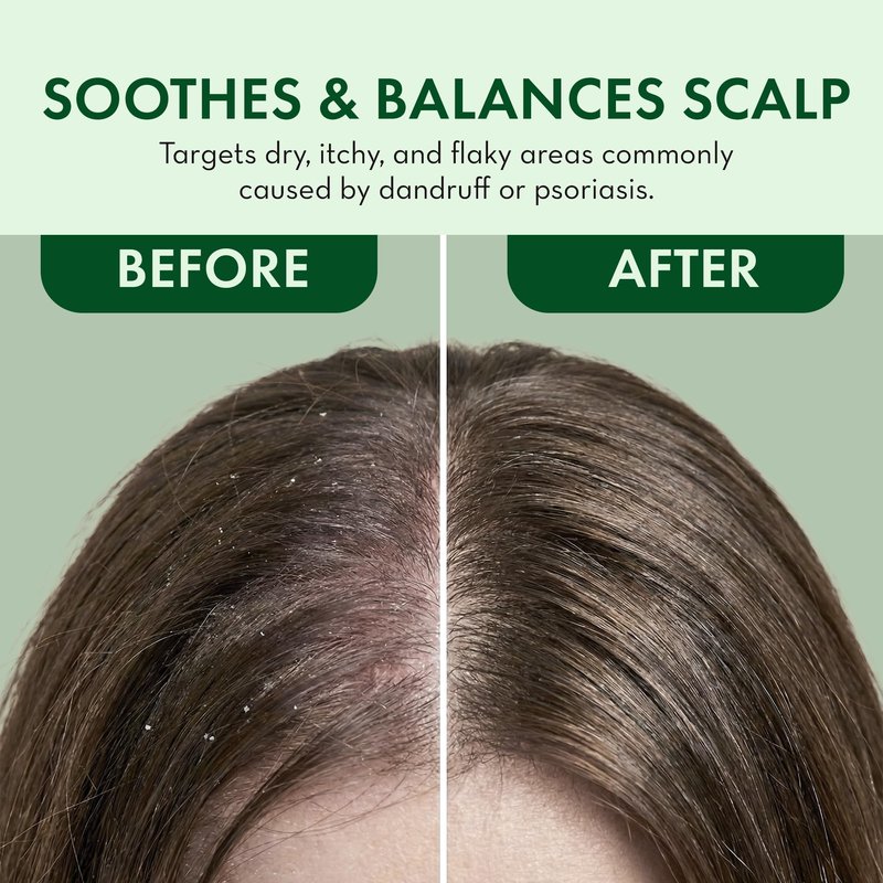 Leave In Conditioner Spray - Rosemary & Mint Scalp Treatment - Anti-Dandruff and Dry & Itchy Scalp treatment, Hydrating & Medicated Formula for Psoriasis and Scalp Care - Detangles & Nourishes Hair.