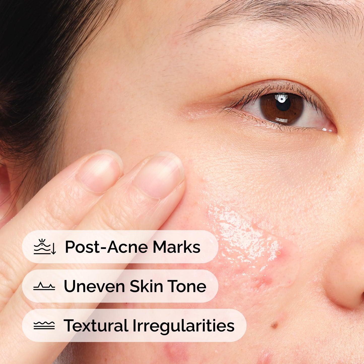 The Ordinary Aloe 2% + NAG 2% Solution, Soothes Skin and Targets Post-Acne Marks, 1 Fl Oz
