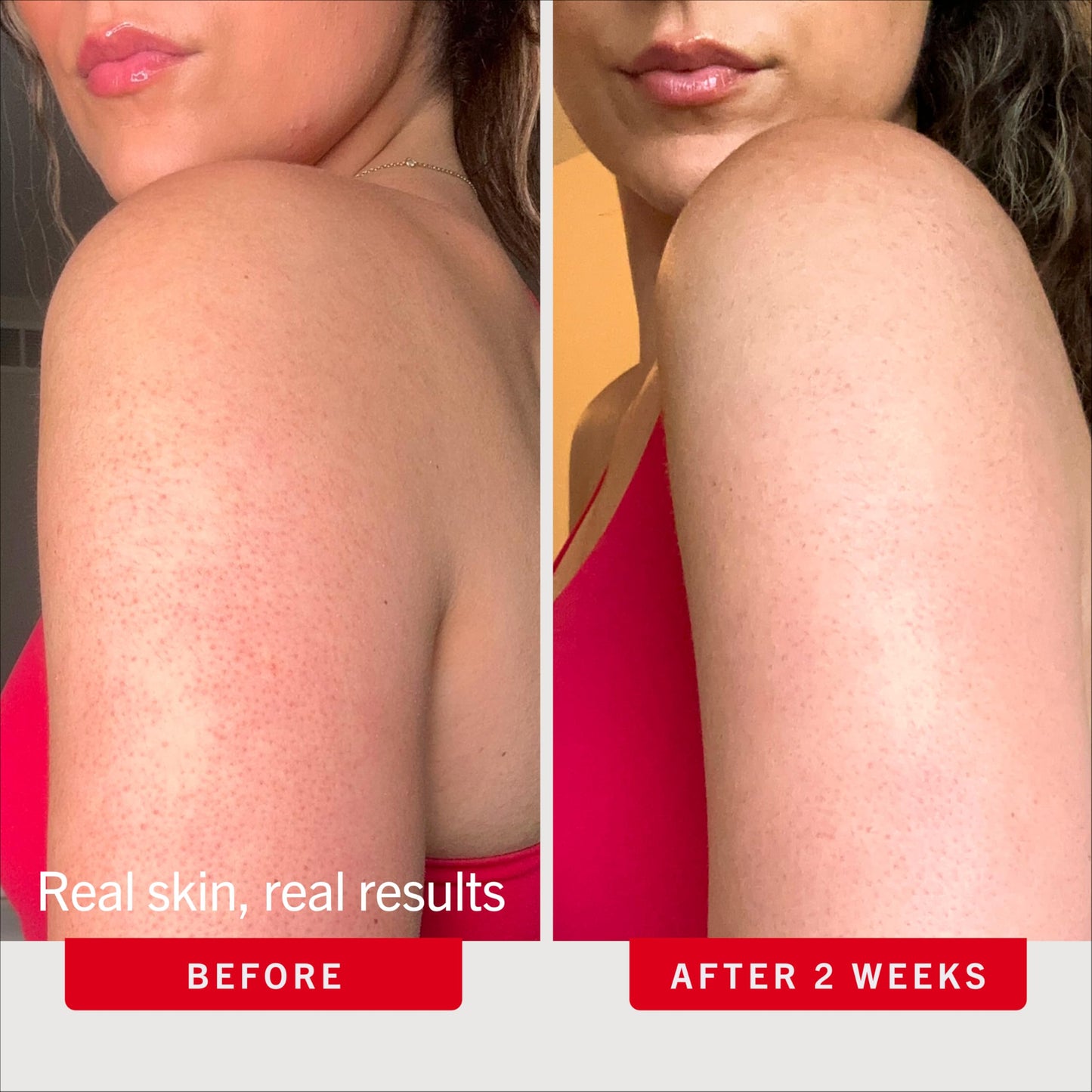 First Aid Beauty KP Bump Eraser Body Scrub with 10% AHA - Dermatologist-Tested Keratosis Pilaris Exfoliator - Support for Rough Bumps & Uneven Skin Texture - Sensitive Skin - 2 oz, Fresh Peach
