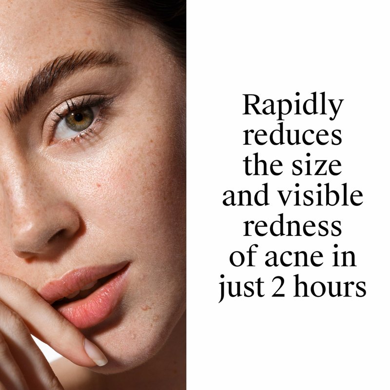 Neutrogena Rapid Clear Stubborn Acne Spot Treatment Gel, Maximum Strength 10% Benzoyl Per-oxide Treatment Medication for Acne Prone Skin, Pimple Cream Reduces Size & Redness, 1 oz