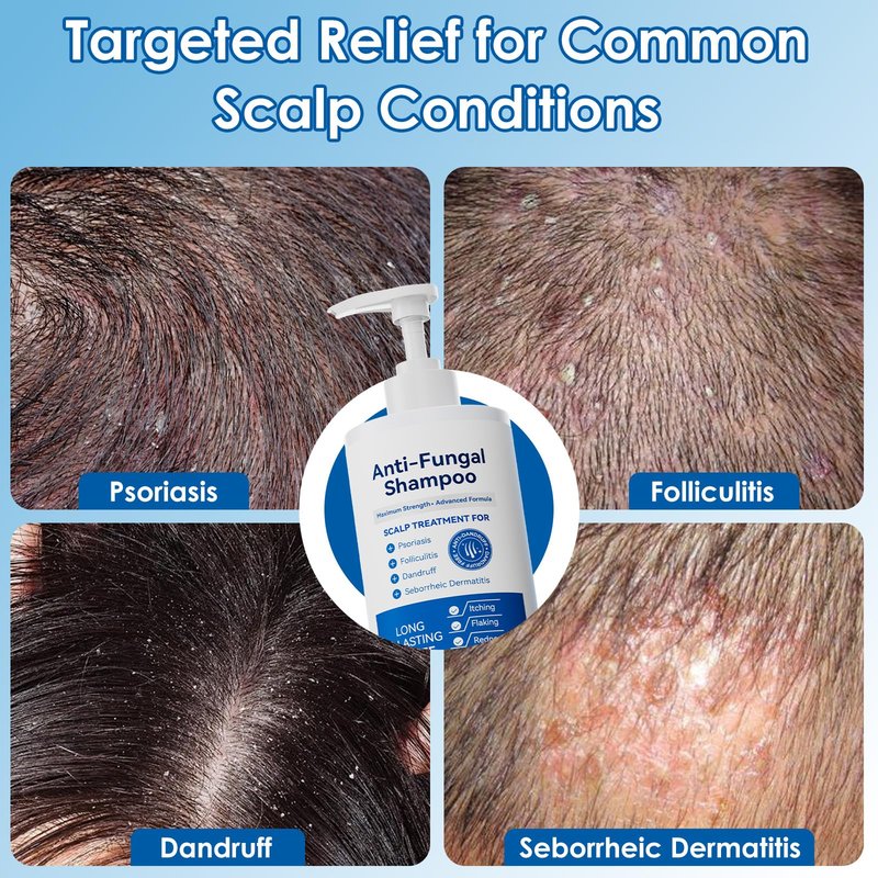 EIUQH Antifungal Shampoo for Seborrheic Dermatitis, Folliculitis, Scalp Psoriasis, Sulfate & Paraben-Free, Anti-Dandruff Formula for Itching, Dryness, and Scalp Relief for Men and Women, 10.14 FL OZ