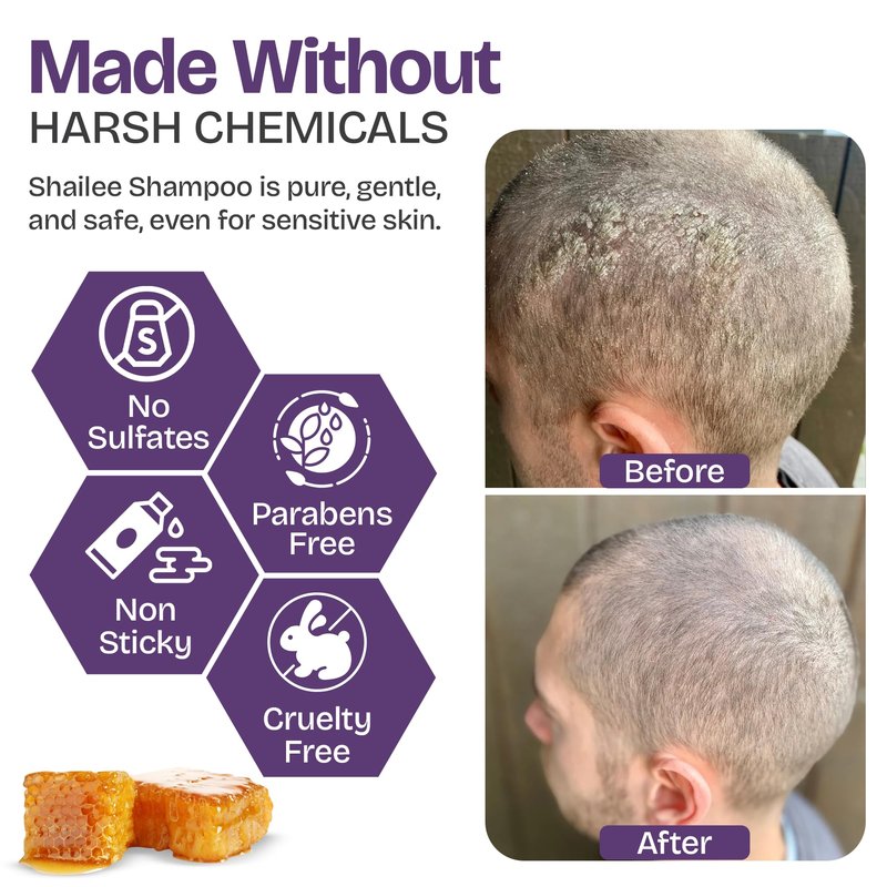 Psoriasis Shampoo for Eczema, and Folliculitis Treatment - Seborrheic Dermatitis Antifungal Shampoo for Ringworm, Acne, Flaking, Dry & Itchy Scalp Treatment - Psoriasis Relief with Manuka Honey