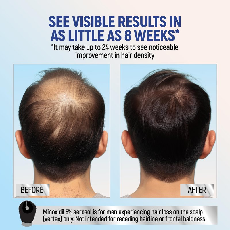 Minoxidil 5% Topical Aerosol Foam, Hair Regrowth 4 Months Treatment for Men, 2.11 oz (4 Pack)