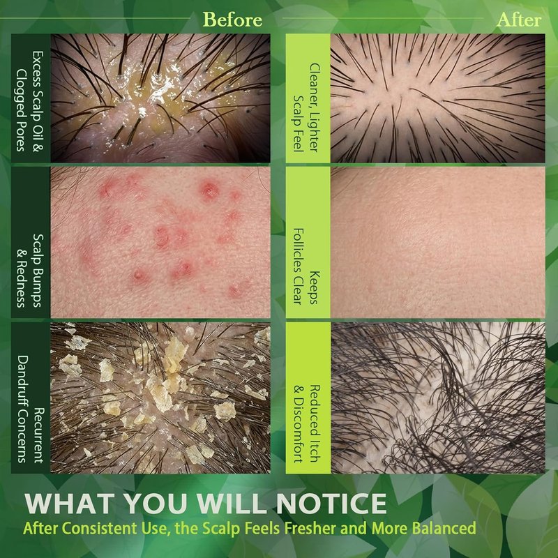 Folliculitis Treatment Shampoo | Antifungal Scalp Cleanser for Seborrheic Dermatitis & Psoriasis - Sulfate-Free, 8 oz