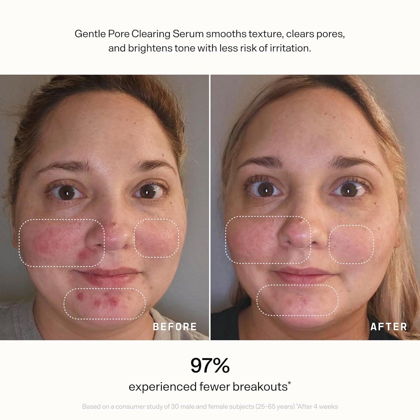 Versed Skin Refine Pore Clearing Serum - Exfoliating Facial Serum with Salicylic & Mandelic Acid | Vegan, 30 ml / 1 fl oz