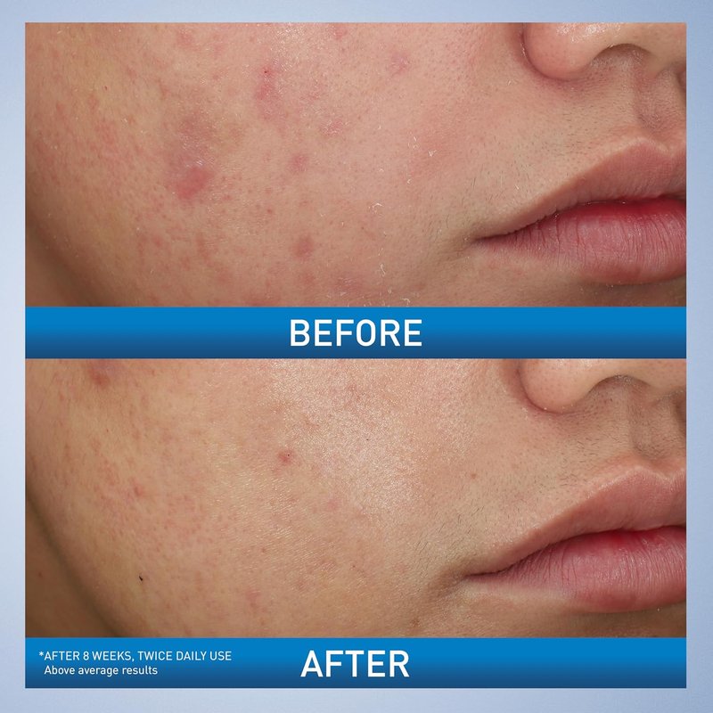 CeraVe Acne Foaming Cream Wash - Gentle Cleanser with 10% Benzoyl Peroxide & Hyaluronic Acid | 5 Oz