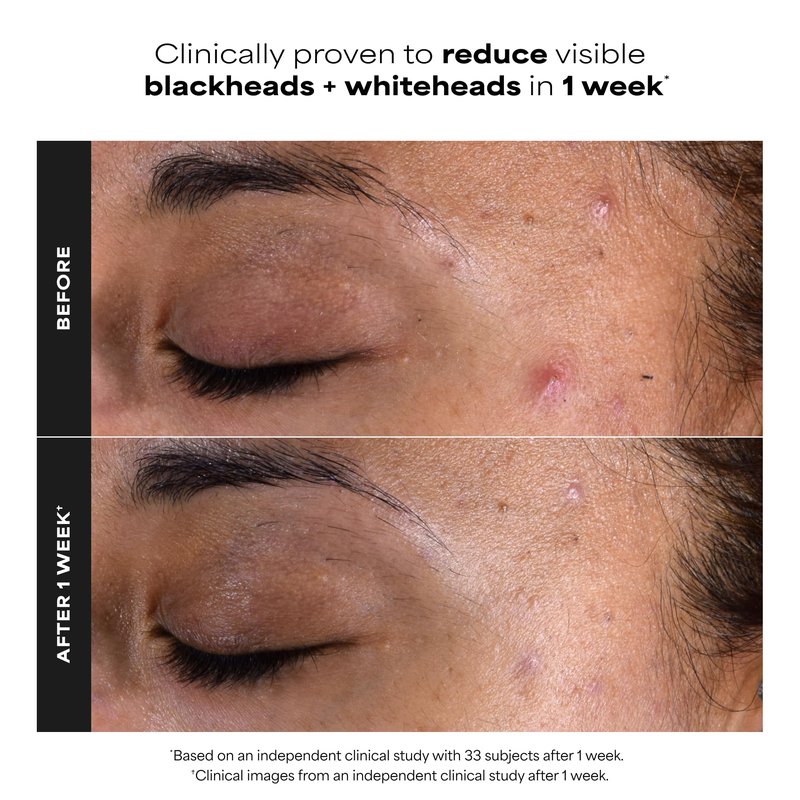 Paula's Choice SKIN PERFECTING 2% BHA Salicylic Acid Exfoliating Pads - Facial Exfoliant Pads for Blackheads, Enlarged Pores, Wrinkles & Fine Lines, 10 ct