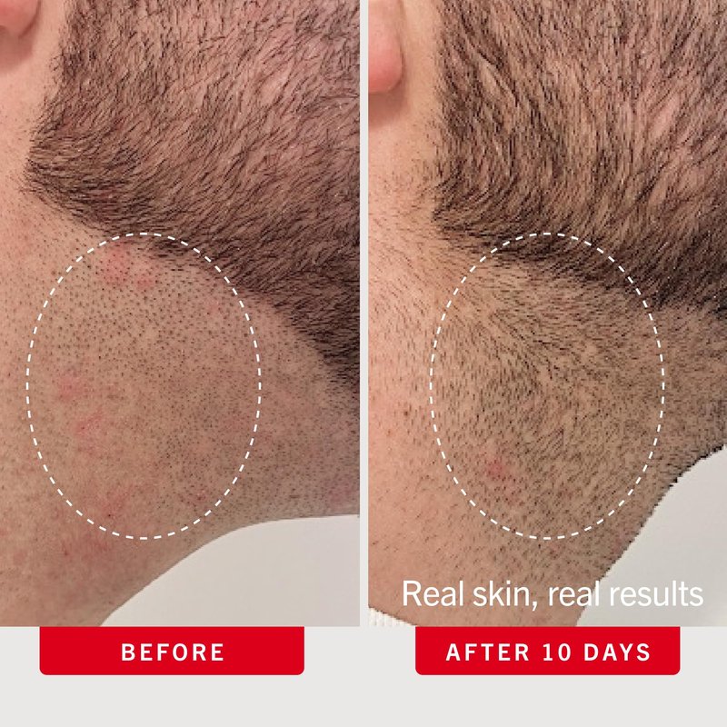 First Aid Beauty Ingrown Hair Pads, Body & Face with BHA & AHA - Dermatologist-Tested Aftershave Treatment to Help Prevent Razor Bumps & Exfoliate Underarms & Bikini Area - Sensitive Skin - 60 Count