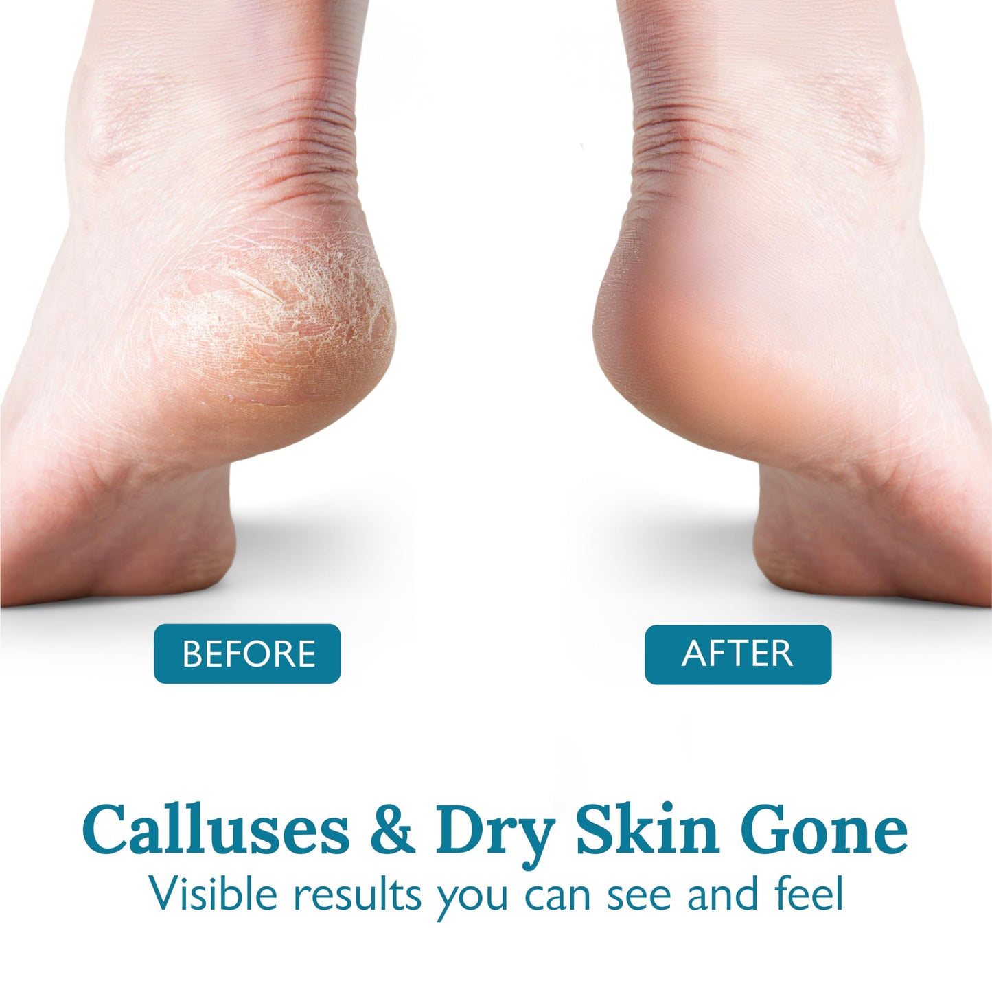 GILDEN TREE Foot Callus Remover Kit - 40% Urea Cream & Handmade Terra-Cotta Pumice Stone for Feet - Callus Remover for Feet with Shea Butter & Aloe Vera - Cracked Heel Treatment & Moisturizer