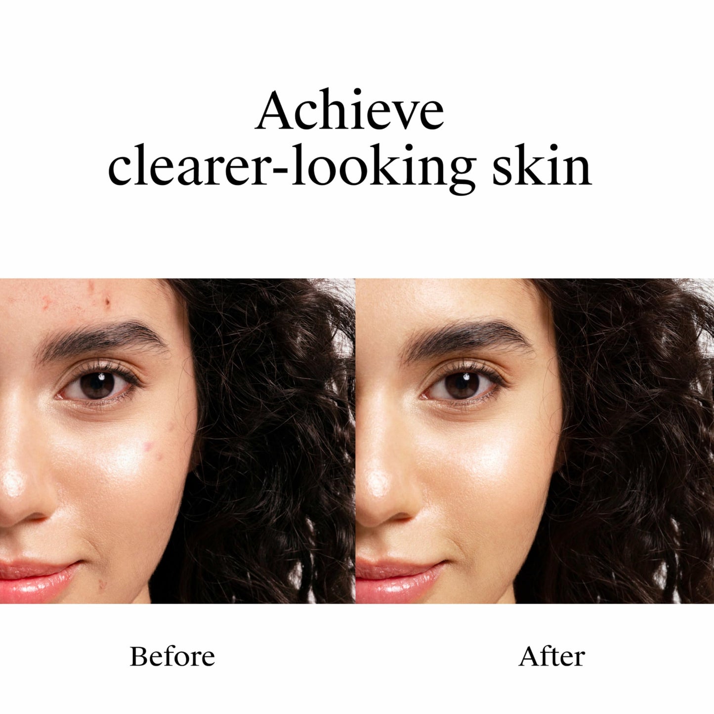 Neutrogena Rapid Clear Stubborn Acne Spot Treatment Gel, Maximum Strength 10% Benzoyl Per-oxide Treatment Medication for Acne Prone Skin, Pimple Cream Reduces Size & Redness, 1 oz