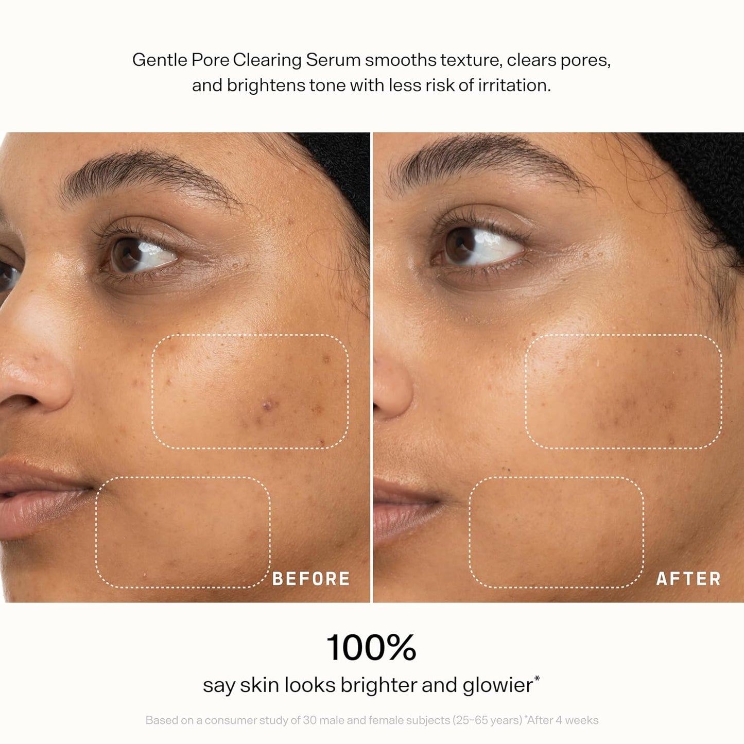 Versed Skin Refine Pore Clearing Serum - Exfoliating Facial Serum with Salicylic & Mandelic Acid | Vegan, 30 ml / 1 fl oz