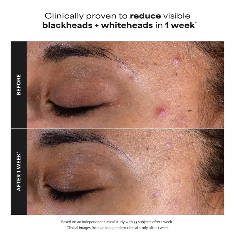 Paula's Choice Skin Perfecting 2% BHA Liquid Exfoliant - Salicylic Acid Facial Polish for Pores & Fine Lines | Fragrance-Free