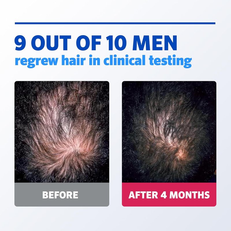 Rogaine Men’s 5% Minoxidil Topical Foam - One Month Supply for Hair Regrowth