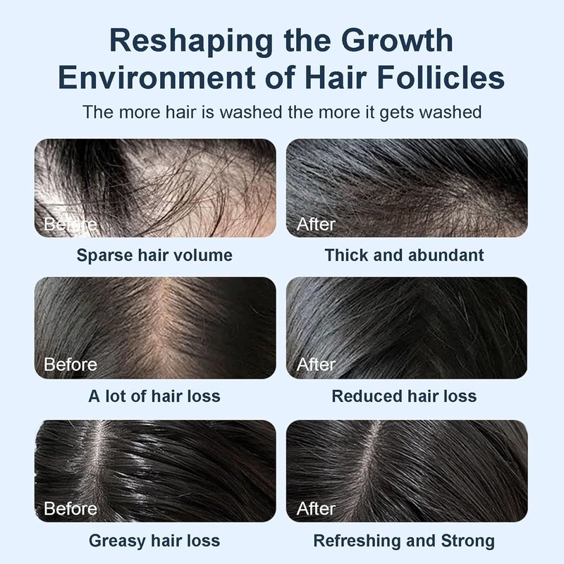 Organic Biotin & Rosemary Hair Growth Shampoo - Thickening Formula with Amino Acids for Hair Loss & Dandruff Control | Unisex
