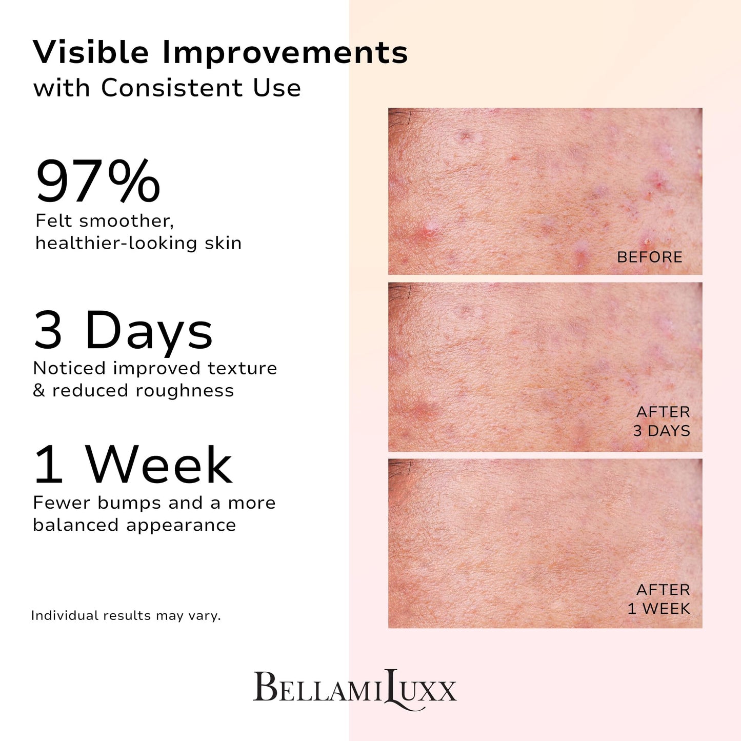 BellamiLuxx Butt Acne Treatment Set: Acne Soap Bar + Butt Treatment Lotion for Breakouts on Buttocks, Thighs, Back, Chest & Ingrown-Prone & Folliculitis-Prone Skin – Helps Reduce Body Breakouts
