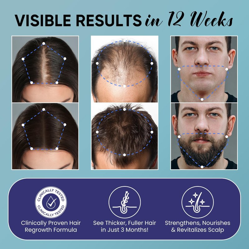 5% Minoxidil for Men and Women Hair Growth Kit: Minoxidil Spray Hair Regrowth Treatment Serum with Biotin & Rosemary -Stop Hair Thinning and Hair Loss For Stronger Thicker Longer Hair 2 Pack