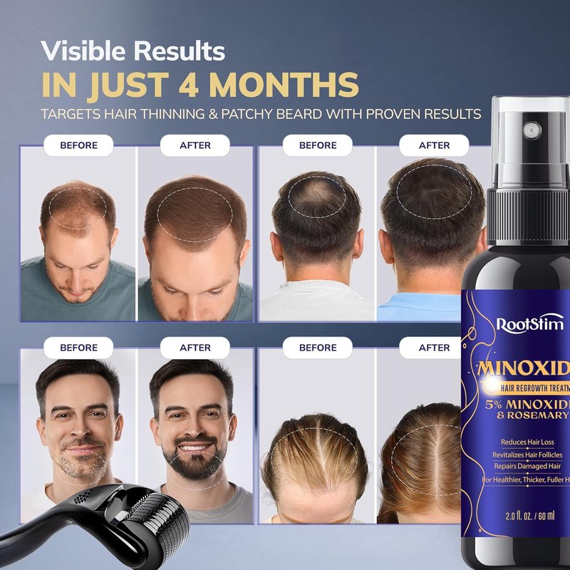 Minoxidil 5% Beard Growth Kit for Men and Women with Rosemary: Extra Strength Minoxidil Hair Regrowth Treatment Spray 2 FL OZ