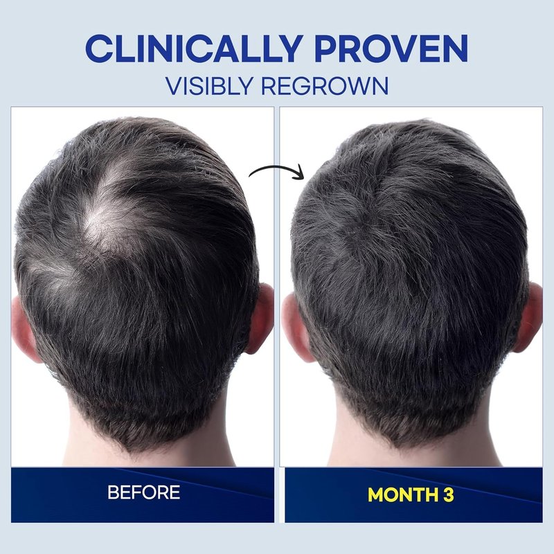 ProBliva 5% Minoxidil for Men Spray: Extra Strength 5% Minoxidil Topical Hair Growth Treatment - Clinically Proven Solution for Hair Loss & Thinning - Made in USA (2 Fl Oz (Pack of 1))