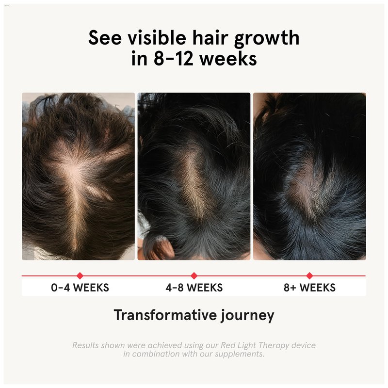 iRestore Hair Growth Supplement - Hair Loss Vitamins for Women and Men - Biotin Multivitamins & DHT Blocker to Reduce Hair Thinning - Hair Regrowth Pills - 30 Days Supply 90 Count (Pack of 1)