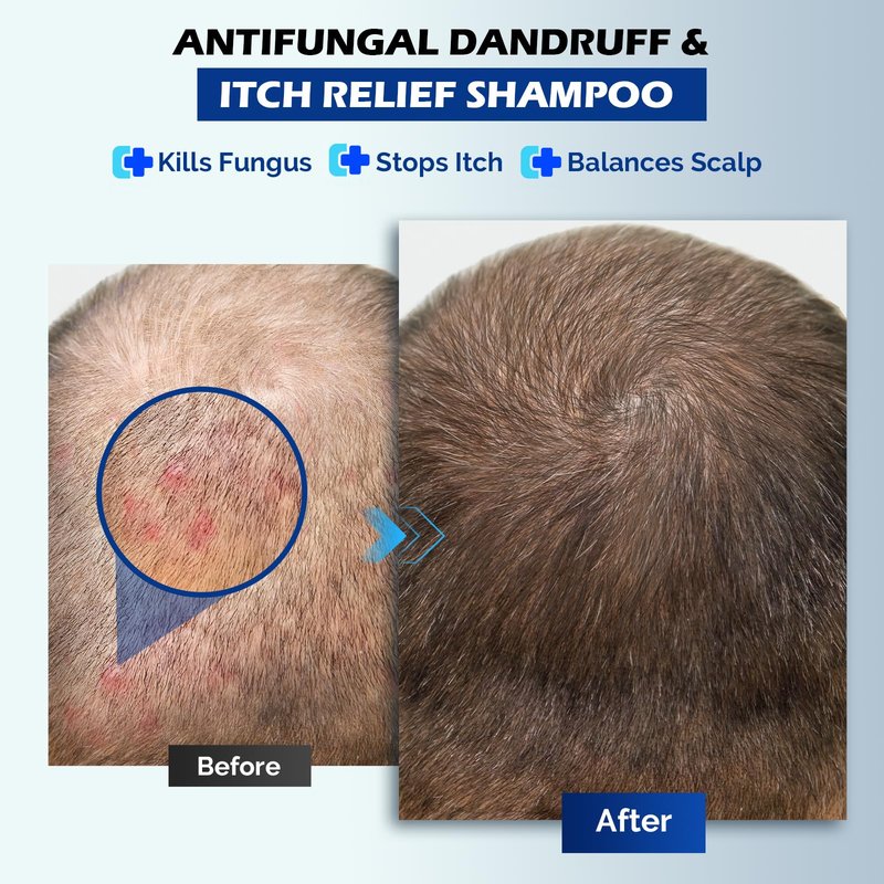 Antifungal Psoriasis Shampoo for Seborrheic Dermatitis, Folliculitis & Scalp Psoriasis, Anti-Dandruff Shampoo for Men & Women, Relieves Scalp Itching, Dryness, Sulfate & Paraben-Free, 10.1 Fl Oz-Fresh