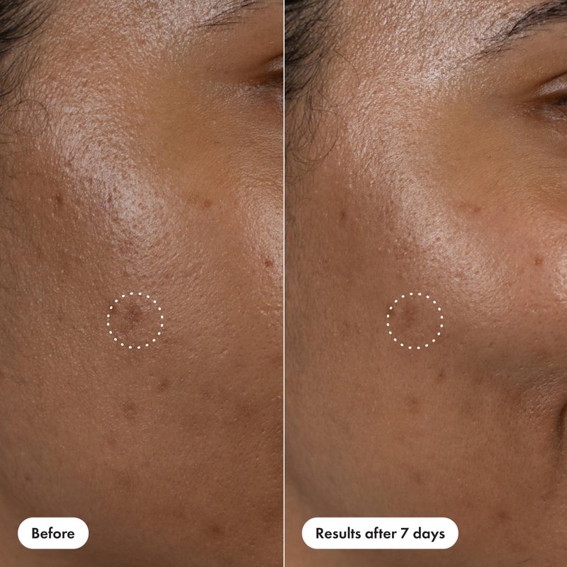 Hero Cosmetics Dark Spot Correct Spot-Fading 15% Vitamin C plus Hyaluronic Acid Serum. Improves the Look of Post Blemish Marks in 7 Days. Twist Applicator and Rollerball Tip for Easy Application. 10mL