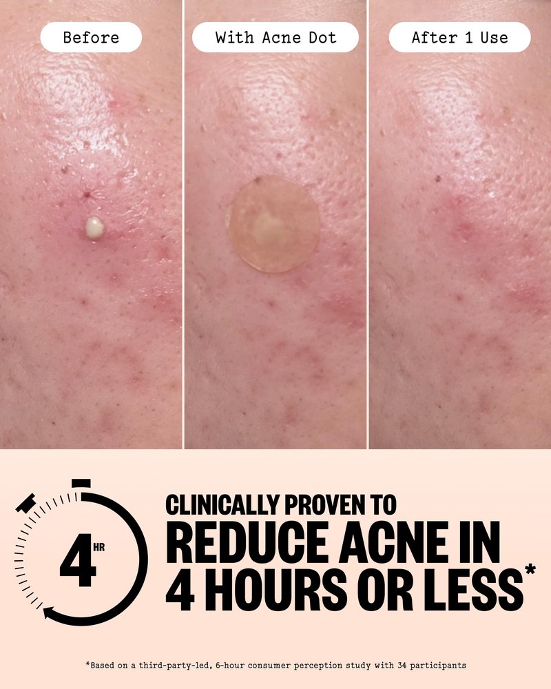 PEACE OUT Acne Day & Night Duo, Invisible Hydrocolloid Pimple Patches for Daytime + Healing Overnight Acne Dots, Clear Blemishes Fast with 2% Salicylic Acid (20 count)