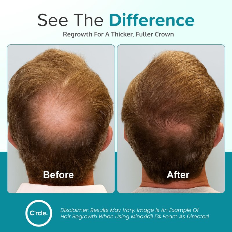 Minoxidil for Men Foam 5% - Unscented 3 Month Supply - Helps Restore Vertex Hair Loss & Thinning - 5% Minoxidil Foam For Men - Extra Strength Supports Hair Regrowth