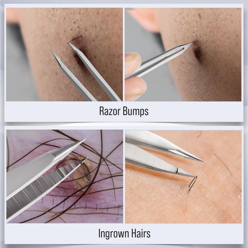DUROX 4-Pc Precision Tweezer Set - 1. Round Tip Tweezers for Facial & Chin Hair 2. Pointed Tweezers for Ingrown Hair & Splinters 3. Professional Eyebrow Tweezers 4. Classic Slant. Stainless Steel.