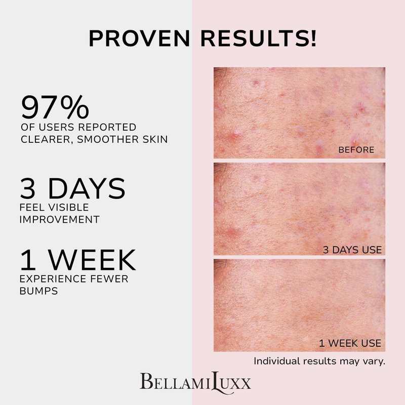 BellamiLuxx Butt Acne Clearing Treatment Cream: Body Acne Treatment for Folliculitis and Pimples on Buttocks, Thighs, and Body with 2% Salicylic Acid & Tea Tree Oil - Butt Cream for Smooth Skin