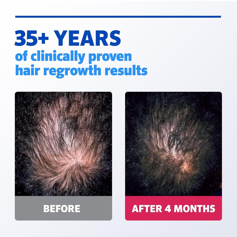 Men's Rogaine Extra Strength 5% Minoxidil | Hair Loss Treatment & Regrowth Solution, Unscented, 2 fl. oz