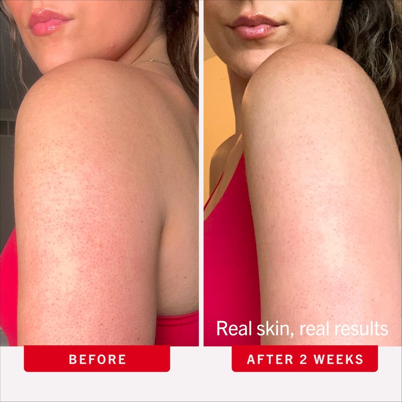 First Aid Beauty KP Bump Eraser Body Scrub with 10% AHA - Dermatologist-Tested Keratosis Pilaris Exfoliator - Support for Rough Bumps & Uneven Skin Texture - Sensitive Skin - 2 oz, Fresh Strawberry