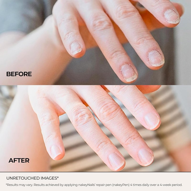 NakeyNails Nail Strengthening Serum - Fast Absorbing Treatment for Damaged & Brittle Nails | 45-Day Supply with Keratin, Peptides & Hyaluronic Acid