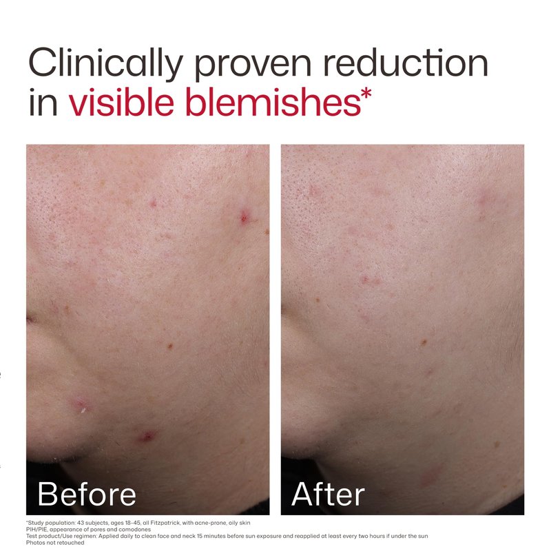 EltaMD UV Clear Blemish-Prone & Oil Balancing SPF 50, Non-Comedogenic Sunscreen with Zinc Oxide, Dermatologist Recommended