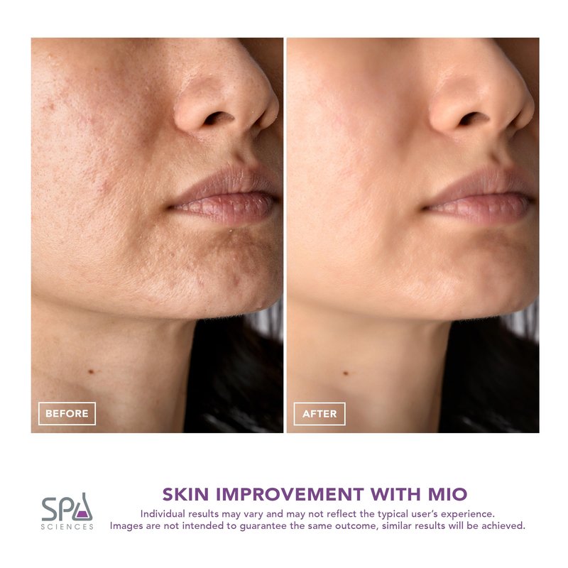 Spa Sciences - MIO - Diamond Tip Microdermabrasion Blackhead Remover, Pore Cleansing, & Resurfacing System - Reduces Acne Scars, Wrinkles, and Exfoliates for Clearer Skin