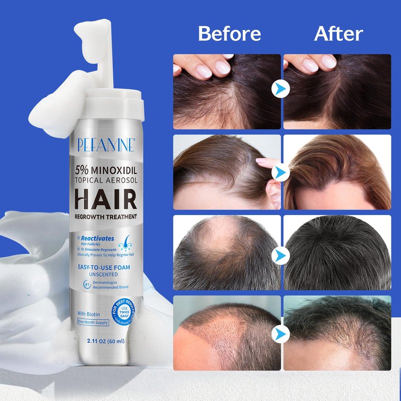 5% Minoxidil Hair Growth Foam, Minoxidil for Men and Women, Hair Regrowth for Men, Beard Growth, Treatment for Scalp Hair Loss Hair Thinning - Increase Thickness and Volume Faster
