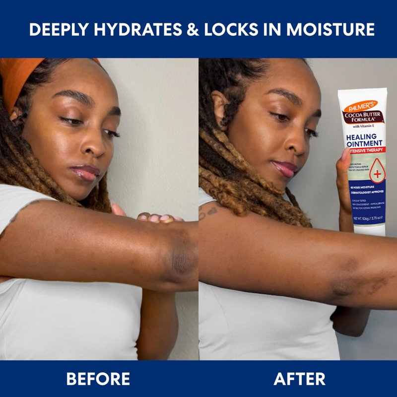 Palmer's Cocoa Butter Formula Healing Ointment with Vitamin E, 3.75 Oz, Intensive Therapy for Severely Dry, Eczema Prone Skin, Provides 48-Hour Moisture, Non-Comedogenic, Dermatologist Approved